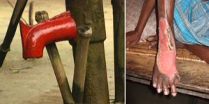 写真1 左）ヒ素が基準値を超えている井戸のポンプには赤いペンキが塗られている。　右）汚染された井戸の水を飲み続け、角質化が進んだヒ素中毒患者の足。
